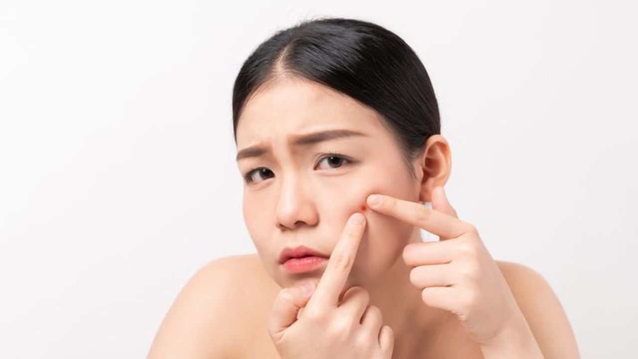 8 ರಿಂದ 16 ವರ್ಷದೊಳಗಿನ ಮಕ್ಕಳಲ್ಲಿ ಮೊಡವೆ ಬೀಳಲು ಈ ಆಹಾರಗಳು ಕಾರಣ