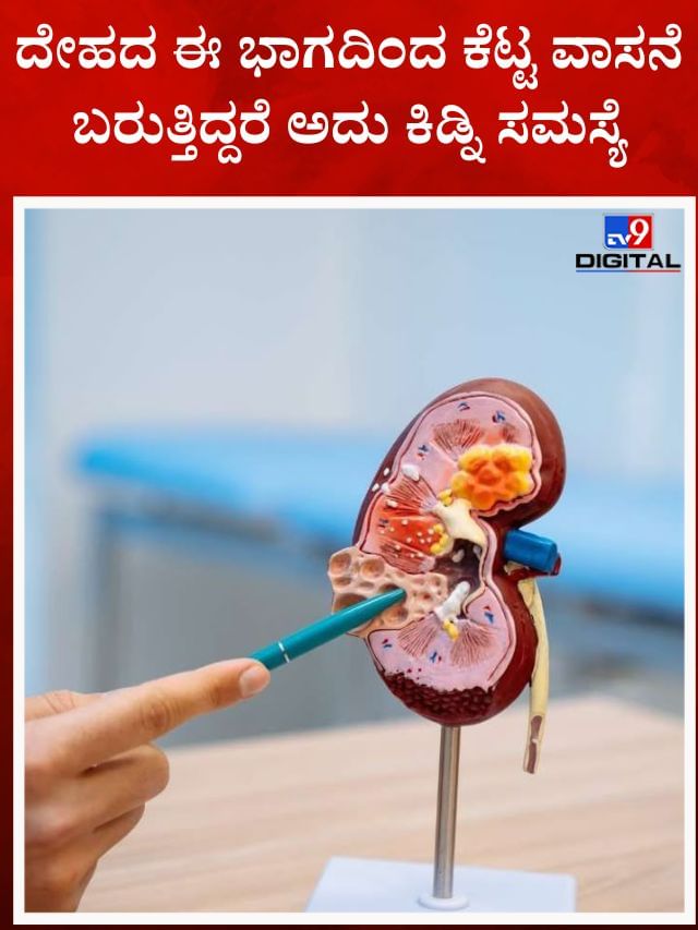 ಚರ್ಮ ಒಣಗುವುದು ಈ ಕಾಯಿಲೆಯ ಲಕ್ಷಣ