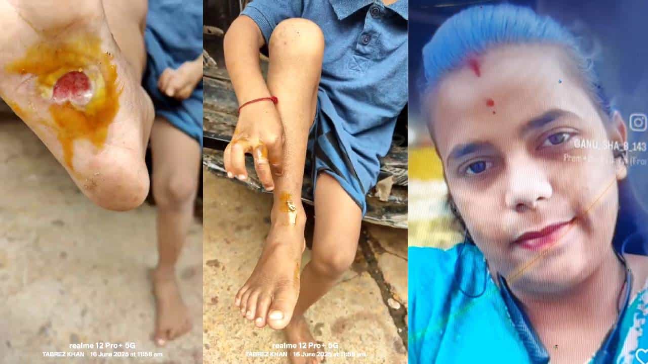 ಹಠ ಮಾಡುತ್ತೆಂದು ಮಗುವಿನ ಮುಖ,ಅಂಗಾಲಿಗೆ ಬರೆ: ಛೇ..ಹೆತ್ತವಳಿಂದ ಇದೆಂಥಾ ಕೃತ್ಯ..