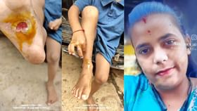 ಹಠ ಮಾಡುತ್ತೆಂದು ಮಗುವಿನ ಮುಖ,ಅಂಗಾಲಿಗೆ ಬರೆ: ಹೆತ್ತವಳಿಂದ ಇದೆಂಥಾ ಕೃತ್ಯ ಹಠ ಮಾಡುತ್ತೆಂದು ಮಗುವಿನ ಮುಖ,ಅಂಗಾಲಿಗೆ ಬರೆ: ಹೆತ್ತವಳಿಂದ ಇದೆಂಥಾ ಕೃತ್ಯ
