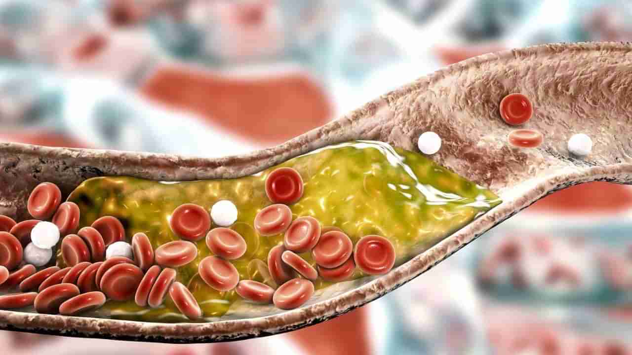 ಕೊಲೆಸ್ಟ್ರಾಲ್ ಕರಗಿಸಿ ಹೃದಯದ ಸಮಸ್ಯೆಗಳನ್ನು ದೂರವಿಡಲು ಇಲ್ಲಿದೆ ಸರಳ ಪರಿಹಾರ