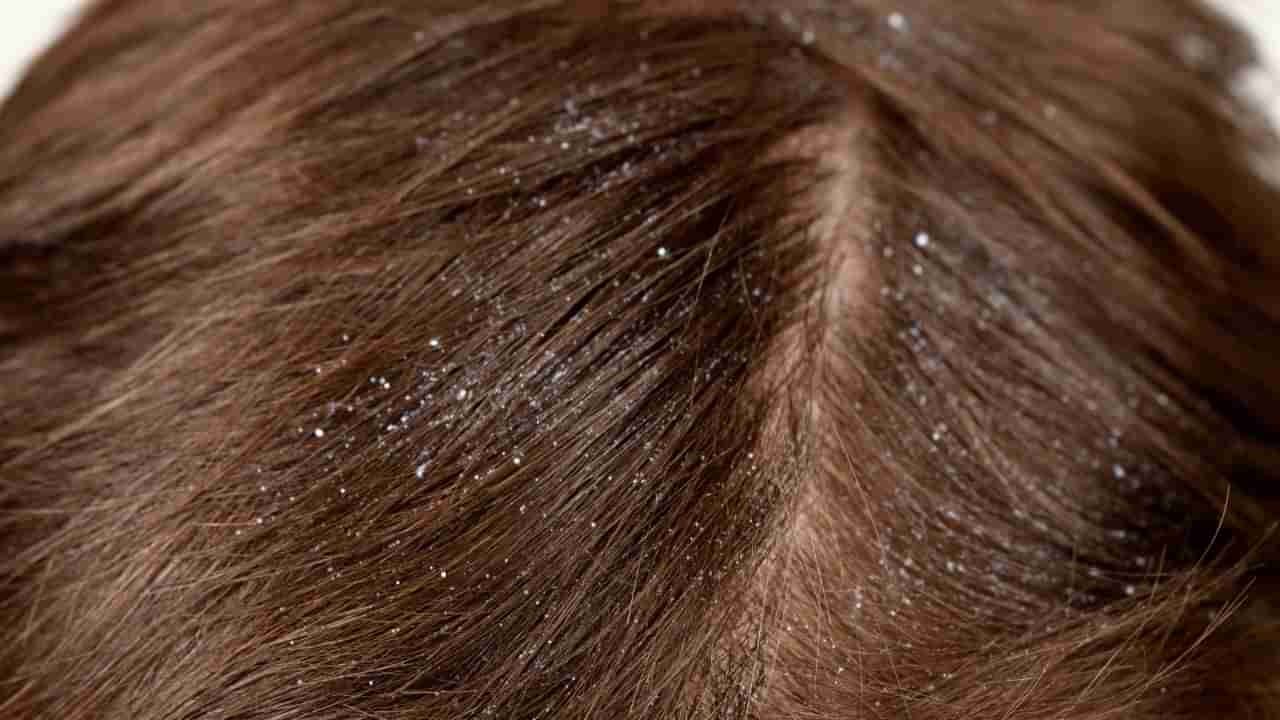 ತಲೆ ಹೊಟ್ಟಿನ ಸಮಸ್ಯೆಯಿಂದ ಬೇಸತ್ತಿದ್ದೀರಾ? ಹಾಗಿದ್ರೆ ಈ ಸರಳ ಸಲಹೆ ಪಾಲಿಸಿ