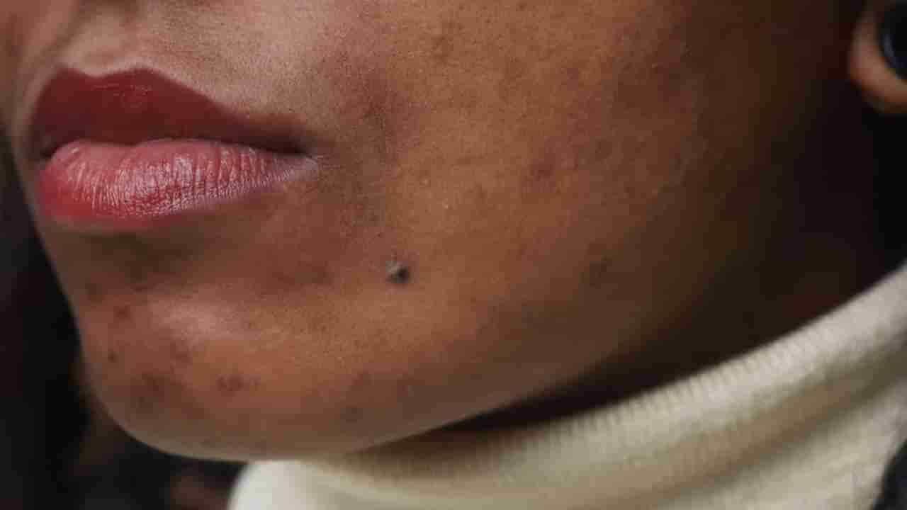 Daily Devotional: ಮುಖದ ಮೇಲೆ ಎಲ್ಲಿ ಮಚ್ಚೆ ಇದ್ದರೆ ಅದೃಷ್ಟ!