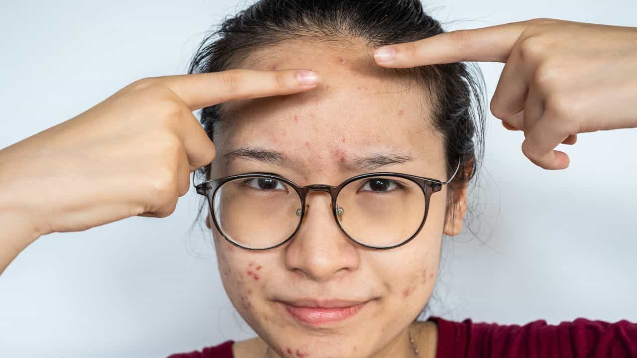 Beauty Tips: ಮೊಡವೆಯಿಂದ ಹಣೆಯ ಚೆಂದ ಹಾಳಾಗಿದ್ಯಾ? ಹಾಗಿದ್ರೆ ಈ ಟಿಪ್ಸ್ ಪಾಲಿಸಿ Beauty Tips: ಮೊಡವೆಯಿಂದ ಹಣೆಯ ಚೆಂದ ಹಾಳಾಗಿದ್ಯಾ? ಹಾಗಿದ್ರೆ ಈ ಟಿಪ್ಸ್ ಪಾಲಿಸಿ