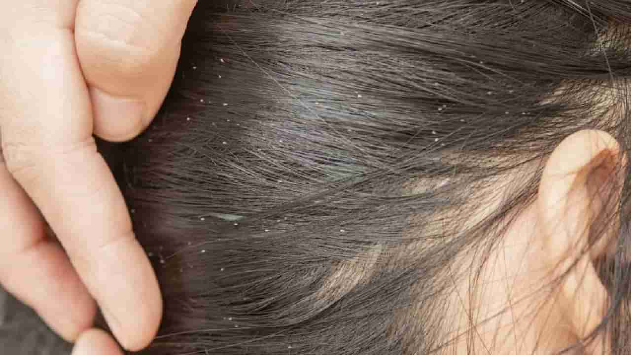 ತಲೆಯಲ್ಲಿ ಹೇನಿನ ಕಿರಿಕಿರಿಯೇ? ಈ ಮದ್ದುಗಳನ್ನು ಬಳಸಿದ್ರೆ ಈ ಸಮಸ್ಯೆಯಿಂದ ಪರಿಹಾರ ಗ್ಯಾರಂಟಿ