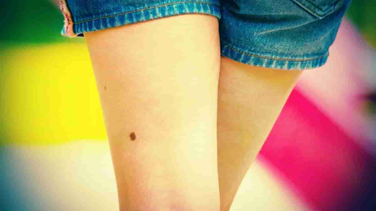 Samudrika Shastra: ಸಾಮುದ್ರಿಕಾ ಶಾಸ್ತ್ರದ ಪ್ರಕಾರ ಮೊಣಕಾಲಿನ ಮೇಲೆ ಮಚ್ಚೆಯಿದ್ದರೆ ಏನರ್ಥ?