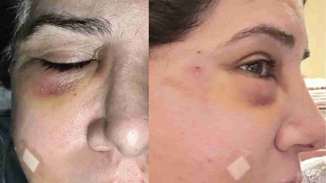 ಪಾಕ್ ನಿರೂಪಕಿಗೆ ಕಣ್ಣು ಊದಿಕೊಳ್ಳುವಂತೆ ಹಲ್ಲೆ ಮಾಡಿದ ಪತಿ