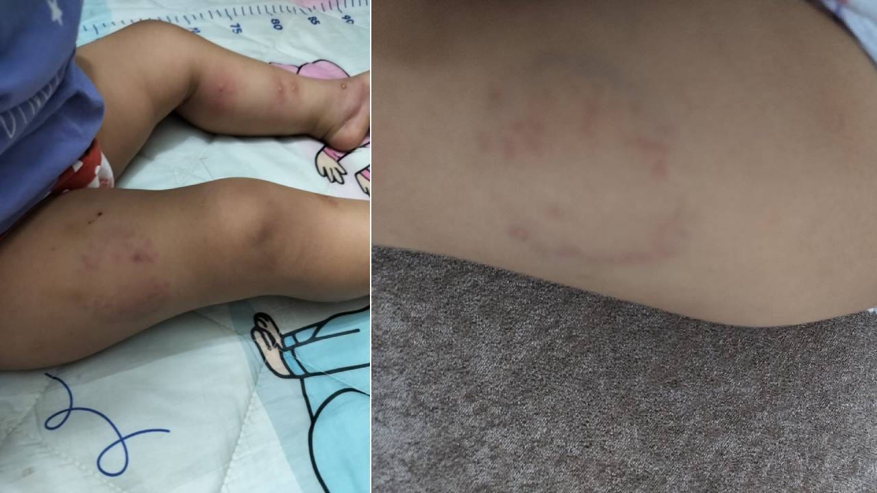 Video: ಮೈಮೇಲೆಲ್ಲಾ ಕಚ್ಚಿದ ಗಾಯ, ಡೇ ಕೇರ್ನಲ್ಲಿರುವ ಮಗುವಿನ ಸ್ಥಿತಿ ಏನಾಗಿದೆ ನೋಡಿ