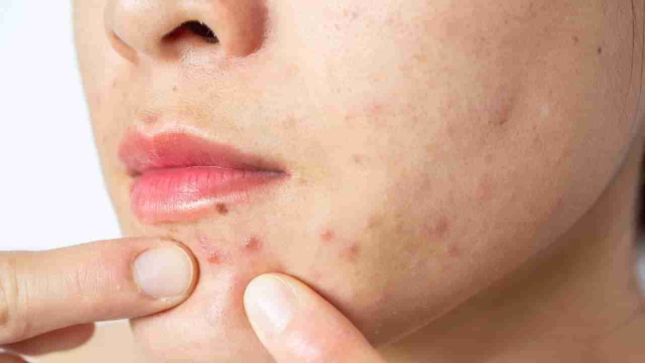 ಮುಖದ ಮೇಲಿನ ಮೊಡವೆ ಸಮಸ್ಯೆಯನ್ನು ಹೋಗಲಾಡಿಸಲು ನಮ್ಮ ಎಂಜಲೇ ಮದ್ದಂತೆ