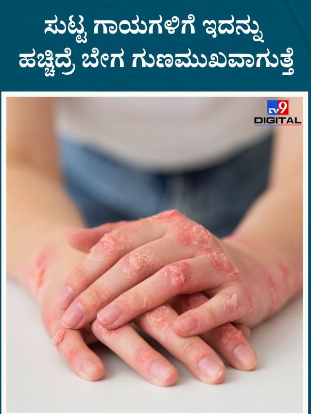 ಸುಟ್ಟ ಗಾಯಗಳಿಗೆ ಇದನ್ನು ಹಚ್ಚಿದ್ರೆ ಸಿಗುತ್ತೆ ತ್ವರಿತ ಪರಿಹಾರ