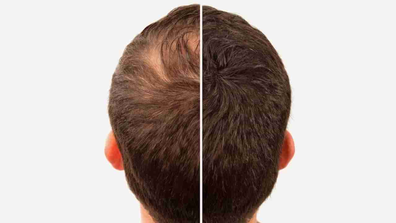 ಈ ಮೂರು ಎಣ್ಣೆಯಲ್ಲಿ ಕೂದಲು ಬೆಳೆಸಿಕೊಳ್ಳುವ ಶಕ್ತಿಯಿದೆ, ಆದರೆ ಉಪಯೋಗಿಸುವಾಗ ಎಚ್ಚರ