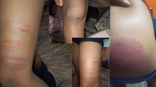 ಬೆಂಗಳೂರು: ದೀಪಾವಳಿ ಹಬ್ಬದ ಮೊದಲ ದಿನವೇ ಪಟಾಕಿ ಅವಘಡ; ಐವರು ಮಕ್ಕಳು ಸೇರಿ ಹಲವರಿಗೆ ಗಾಯ