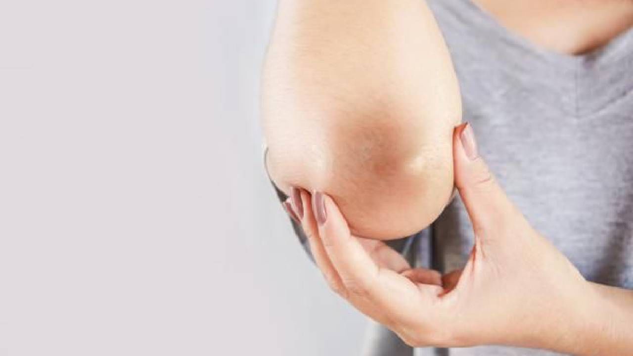 ಮೊಣಕೈ ಕಪ್ಪು ಕಲೆಯನ್ನು ಹೋಗಲಾಡಿಸಲು ಅಡುಗೆ ಮನೆಯಲ್ಲಿ ಲಭ್ಯವಿರುವ ಈ ವಸ್ತುಗಳೇ ಸಾಕು