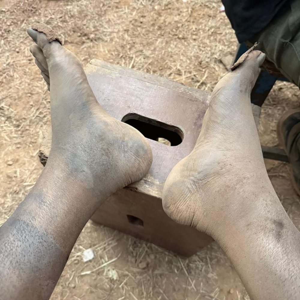 ಇದೀಗ ರಿಷಬ್ ಶೆಟ್ಟಿ ತಮ್ಮ ಕಾಲುಗಳ ಚಿತ್ರಗಳನ್ನು ಇನ್​​ಸ್ಟಾಗ್ರಾಂನಲ್ಲಿ ಹಂಚಿಕೊಂಡಿದ್ದು, ರಿಷಬ್ ಶೆಟ್ಟಿಯವರ ಊದಿಕೊಂಡಿರುವ ಕಾಲುಗಳೇ ಹೇಳುತ್ತಿವೆ ಕಾಂತಾರದ ಹಿಂದಿರುವ ಶ್ರಮದ ಕತೆಯನ್ನು.