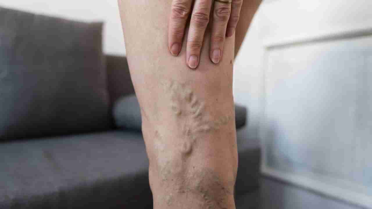 ಋತುಬಂಧವು ವೆರಿಕೋಸ್ ವೇನ್ಸ್‌ಗೆ ಕಾರಣವಾಗಬಹುದೇ? ವೈದ್ಯರು ನೀಡಿರುವ ಮಾಹಿತಿ ಇಲ್ಲಿದೆ