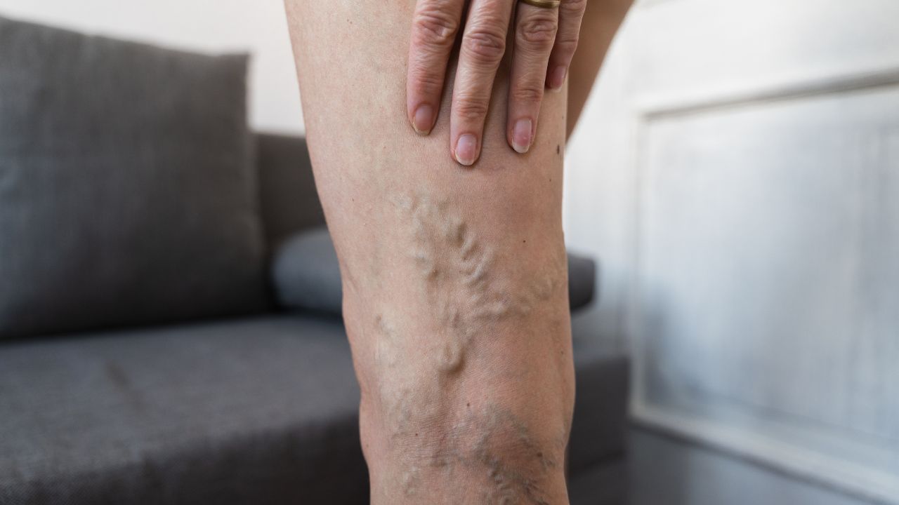 ಋತುಬಂಧವು ವೆರಿಕೋಸ್ ವೇನ್ಸ್‌ಗೆ ಕಾರಣವಾಗಬಹುದೇ? ವೈದ್ಯರು ನೀಡಿರುವ ಮಾಹಿತಿ ಇಲ್ಲಿದೆ