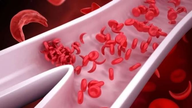 ಮಕ್ಕಳಲ್ಲಿ ರಕ್ತಹೀನತೆ: ಶಾಕ್​ ಆಗುವಂತಿದೆ ಆರೋಗ್ಯ ಇಲಾಖೆ ಅಂಕಿ ಅಂಶ