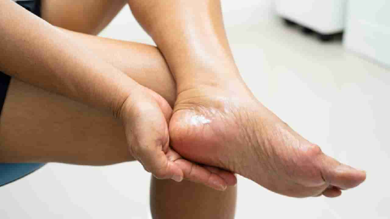 Winter Tips: ಬಿರುಕು ಬಿಟ್ಟ ಹಿಮ್ಮಡಿಯನ್ನು ಗುಣಪಡಿಸಲು ಸಹಕಾರಿ ಈ ಮನೆಮದ್ದುಗಳು