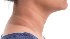 ಕತ್ತಿನ ಸುತ್ತಲಿನ ಕಪ್ಪು ಕಲೆಯನ್ನು ನಿವಾರಿಸುವ ಪರಿಣಾಮಕಾರಿ ಮನೆಮದ್ದುಗಳಿವು