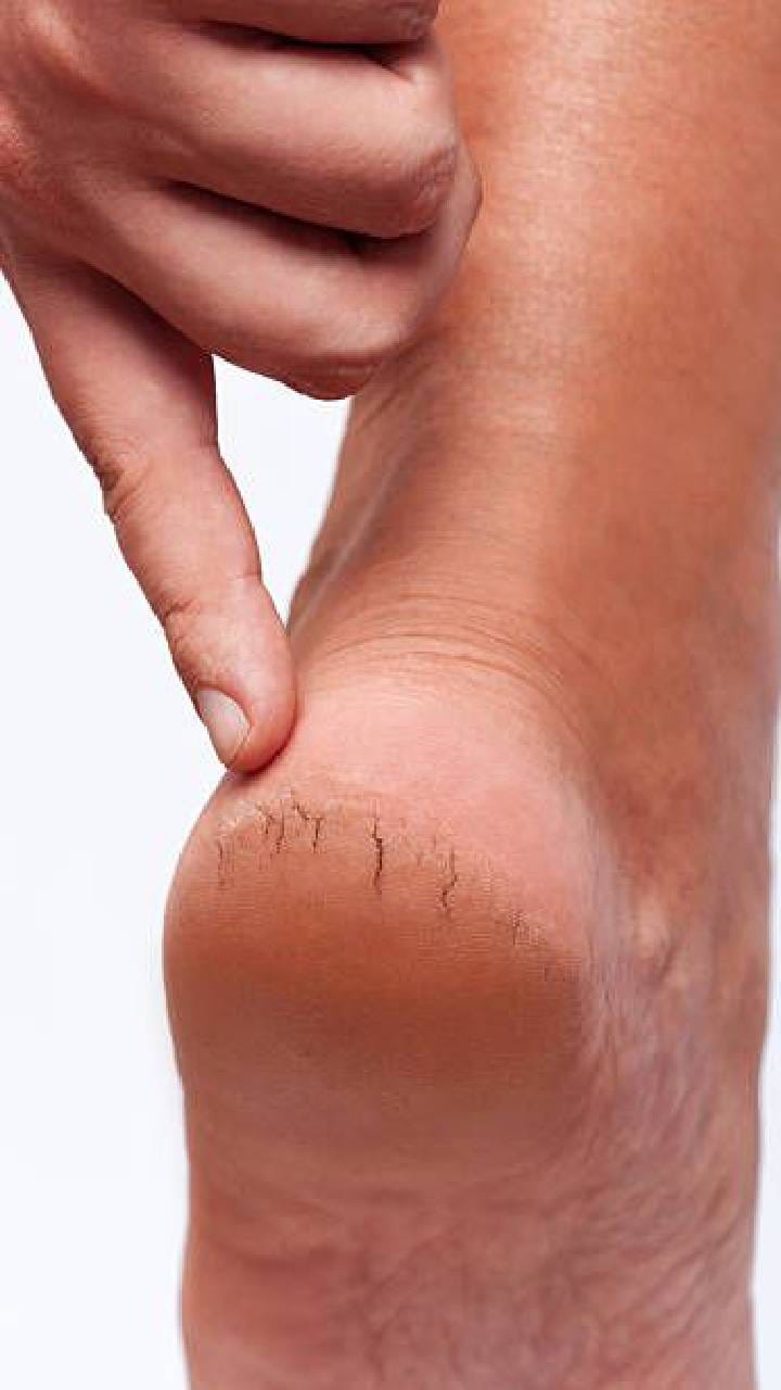 ಒಡೆದ ಹಿಮ್ಮಡಿಗೆ ಇಲ್ಲಿದೆ ಸರಳ ಪರಿಹಾರ