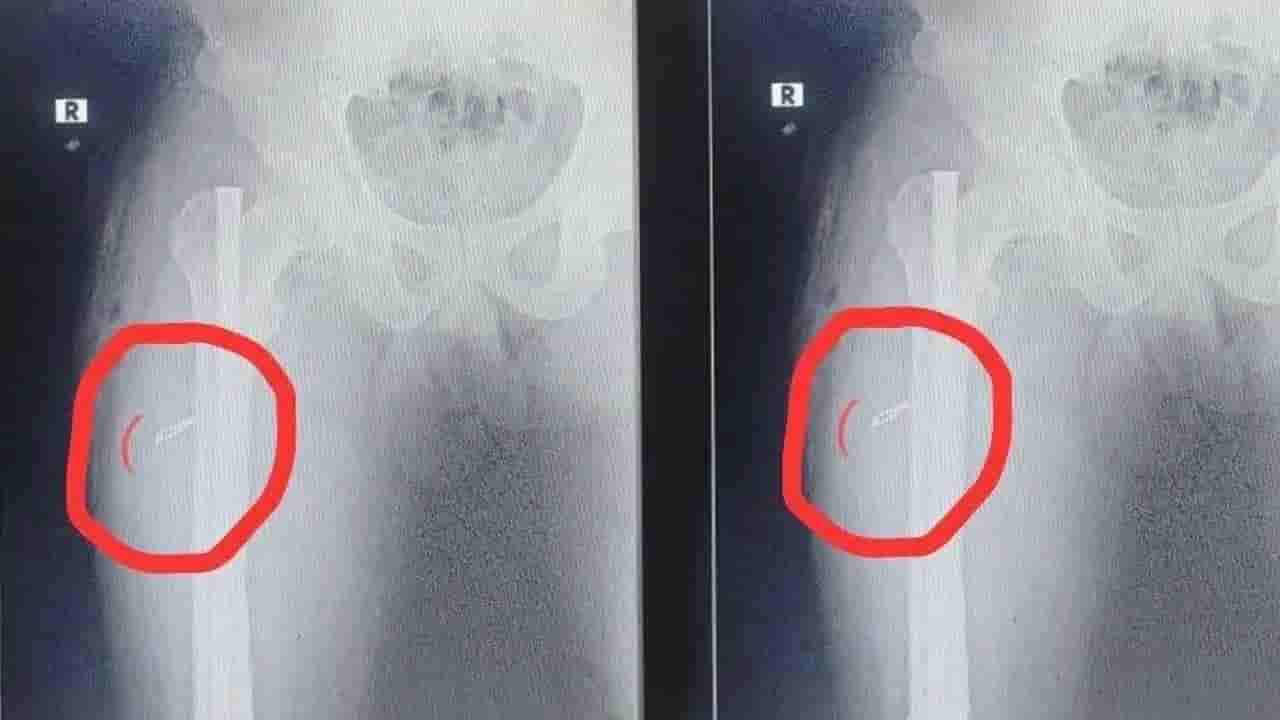 ಕಾಲಿಗೆ ಶಸ್ತ್ರಚಿಕಿತ್ಸೆ ಮಾಡಿದ್ರೂ ಮತ್ತೆ ಕಾಣಿಸಿಕೊಂಡ ನೋವು, ಸ್ಕ್ಯಾನಿಂಗ್‌ ವೇಳೆ ತಿಳಿಯಿತು ವೈದ್ಯರ ಎಡವಟ್ಟು