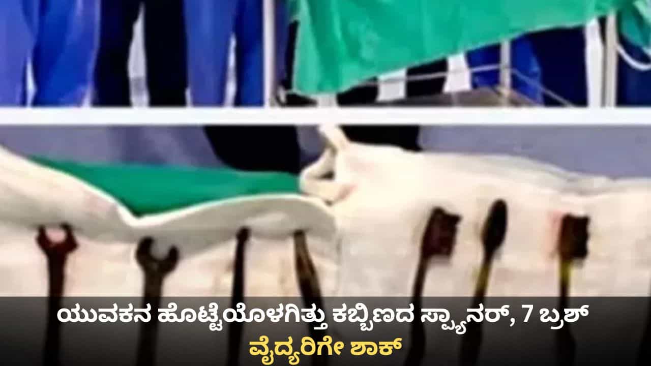ಯುವಕನ ಹೊಟ್ಟೆಯೊಳಗಿತ್ತು ಕಬ್ಬಿಣದ ಸ್ಪ್ಯಾನರ್‌, 7 ಬ್ರಶ್; ಆಪರೇಷನ್ ಮಾಡಿದ ವೈದ್ಯರಿಗೇ ಶಾಕ್