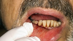 ಒಸಡುಗಳಲ್ಲಿ ರಕ್ತ ಬರುವುದು ಡಯಾಬಿಟಿಸ್ ಬರುವ ಮುನ್ಸೂಚನೆಯೇ?