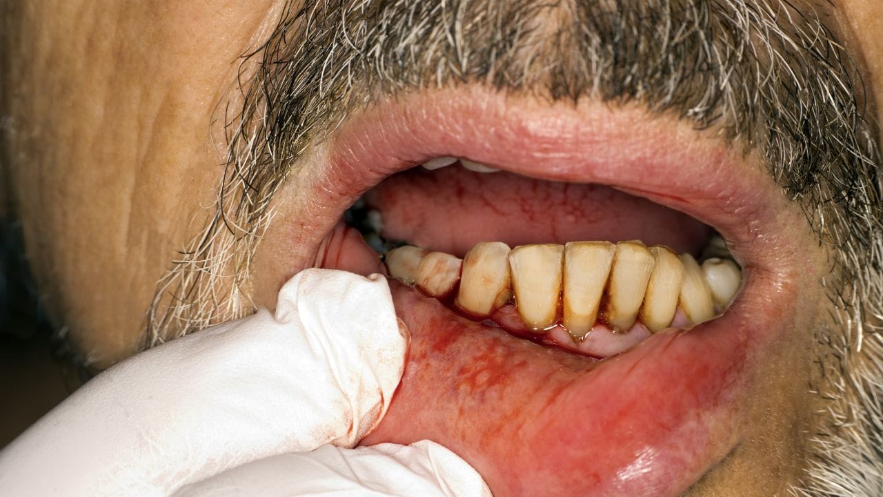 ಒಸಡುಗಳಲ್ಲಿ ರಕ್ತ ಬರುವುದು ಡಯಾಬಿಟಿಸ್ ಬರುವ ಮುನ್ಸೂಚನೆಯೇ? ಈ ಬಗ್ಗೆ ಇಂಟ್ರೆಸ್ಟಿಂಗ್ ಮಾಹಿತಿ ಇಲ್ಲಿದೆ ಒಸಡುಗಳಲ್ಲಿ ರಕ್ತ ಬರುವುದು ಡಯಾಬಿಟಿಸ್ ಬರುವ ಮುನ್ಸೂಚನೆಯೇ? ಈ ಬಗ್ಗೆ ಇಂಟ್ರೆಸ್ಟಿಂಗ್ ಮಾಹಿತಿ ಇಲ್ಲಿದೆ