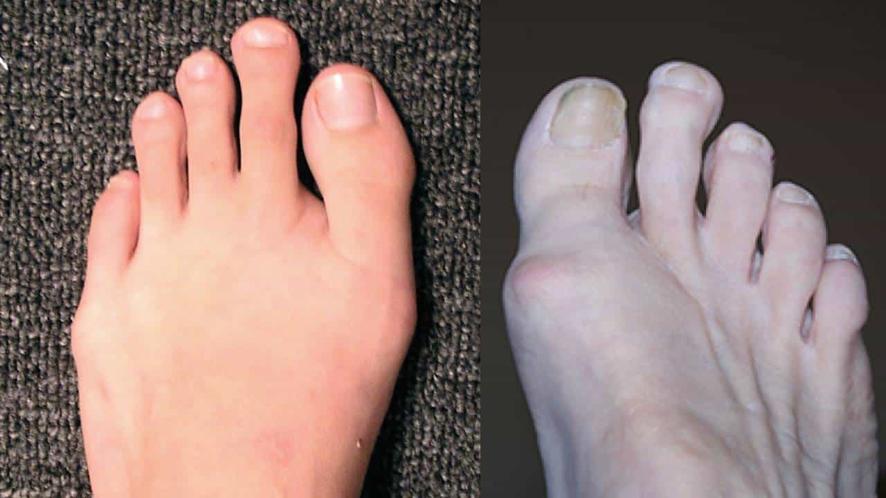 Toe Length Astrology: ಕಾಲಿನ ಹೆಬ್ಬೆರಳಿಗಿಂತ ಪಕ್ಕದ ಬೆರಳು ಉದ್ದ ಇದ್ರೆ ಏನರ್ಥ ಗೊತ್ತಾ? Toe Length Astrology: ಕಾಲಿನ ಹೆಬ್ಬೆರಳಿಗಿಂತ ಪಕ್ಕದ ಬೆರಳು ಉದ್ದ ಇದ್ರೆ ಏನರ್ಥ ಗೊತ್ತಾ?