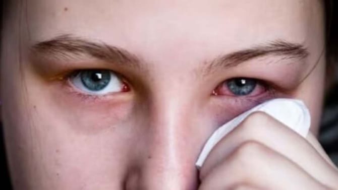 ಶೀತಗಾಳಿ ಪ್ರಭಾವ ಬೆನ್ನಲ್ಲೇ ಮದ್ರಾಸ್ ಐ ಸೋಂಕು ಹೆಚ್ಚಳ: ಮಕ್ಕಳೇ ಟಾರ್ಗೆಟ್​