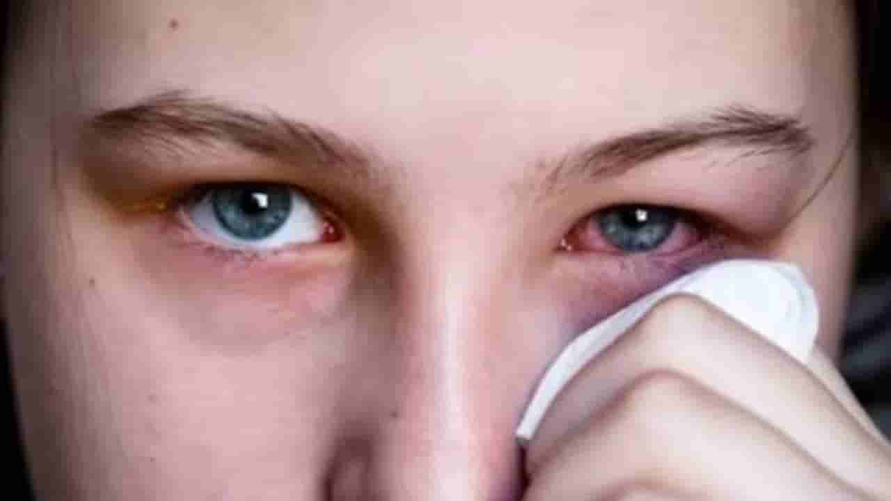 Madras Eye: ಶೀತಗಾಳಿ ಪ್ರಭಾವ ಬೆನ್ನಲ್ಲೇ ಮದ್ರಾಸ್ ಐ ಸೋಂಕು ಹೆಚ್ಚಳ: ಮಕ್ಕಳೇ ಟಾರ್ಗೆಟ್