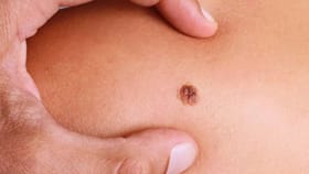 ದೇಹದ ಈ ಭಾಗದಲ್ಲಿ ಮಚ್ಚೆ ಇರುವವರಿಗೆ ಯಶಸ್ಸು ಖಂಡಿತಾ!