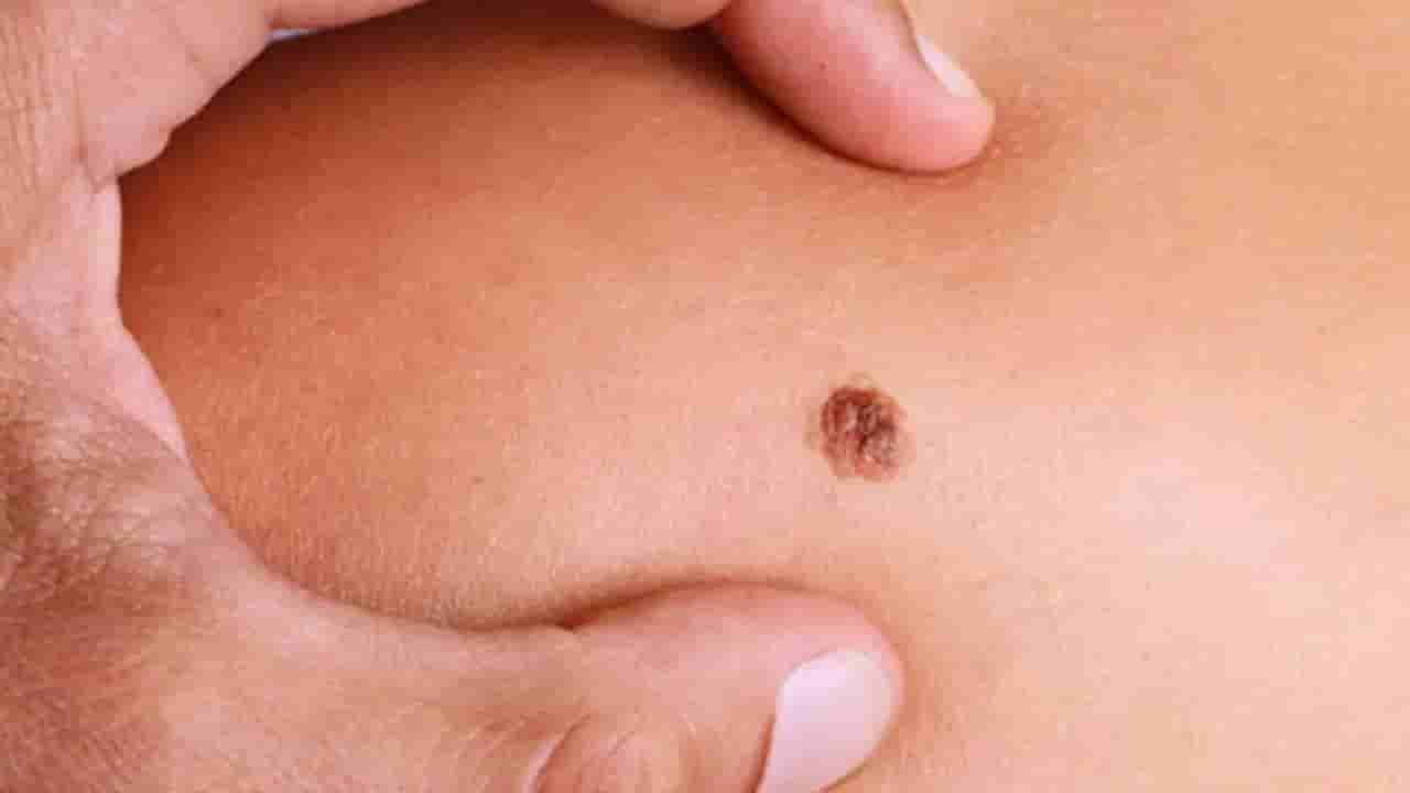 Samudrika Shastra: ದೇಹದ ಈ ಭಾಗದಲ್ಲಿ ಮಚ್ಚೆ ಇರುವವರಿಗೆ ಯಶಸ್ಸು ಖಂಡಿತಾ!