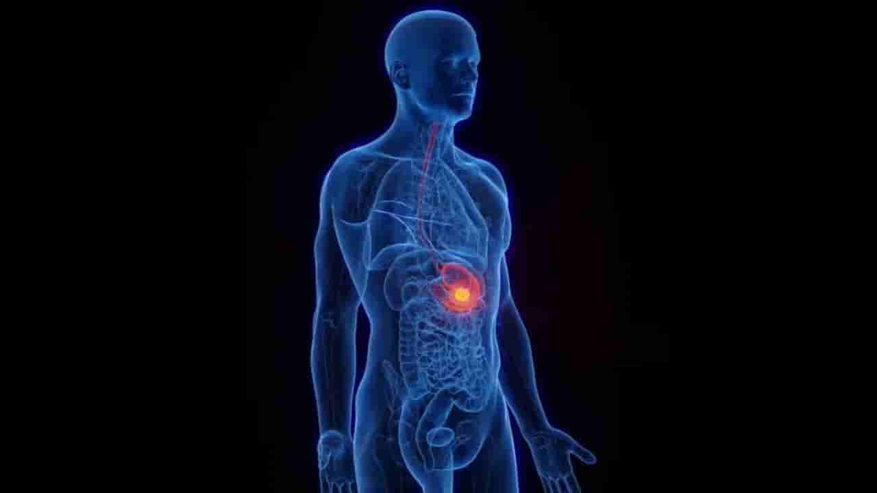 ನಿರಂತರವಾಗಿ ಕಂಡುಬರುವ ಮಲಬದ್ಧತೆ ಸಮಸ್ಯೆ ಹೊಟ್ಟೆಯ ಕ್ಯಾನ್ಸರ್ ಗೆ ಕಾರಣವಾಗಬಹುದೇ?