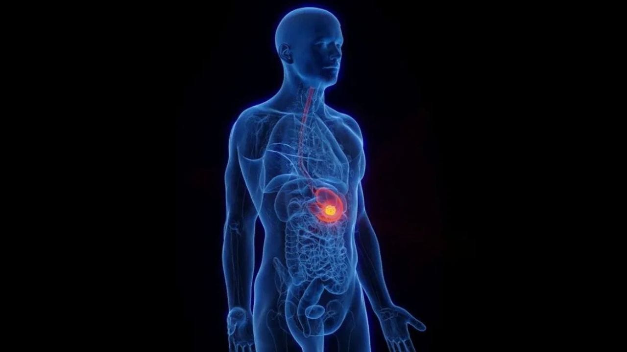 ನಿರಂತರವಾಗಿ ಕಂಡುಬರುವ ಮಲಬದ್ಧತೆ ಸಮಸ್ಯೆ ಹೊಟ್ಟೆಯ ಕ್ಯಾನ್ಸರ್ ಗೆ ಕಾರಣವಾಗಬಹುದೇ? ನಿರಂತರವಾಗಿ ಕಂಡುಬರುವ ಮಲಬದ್ಧತೆ ಸಮಸ್ಯೆ ಹೊಟ್ಟೆಯ ಕ್ಯಾನ್ಸರ್ ಗೆ ಕಾರಣವಾಗಬಹುದೇ?