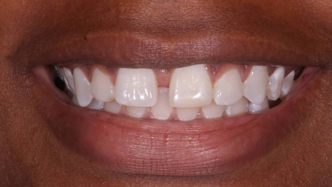 Teeth Gap Fortune: ನಿಮ್ಮ ಹಲ್ಲುಗಳ ನಡುವೆ ಅಂತರವಿದೆಯೇ? ಜ್ಯೋತಿಷ್ಯ ಮತ್ತು ಸಾಮುದ್ರಿಕ ಶಾಸ್ತ್ರ ಹೇಳುವುದೇನು ಗೊತ್ತಾ? Teeth Gap Fortune: ನಿಮ್ಮ ಹಲ್ಲುಗಳ ನಡುವೆ ಅಂತರವಿದೆಯೇ? ಜ್ಯೋತಿಷ್ಯ ಮತ್ತು ಸಾಮುದ್ರಿಕ ಶಾಸ್ತ್ರ ಹೇಳುವುದೇನು ಗೊತ್ತಾ?