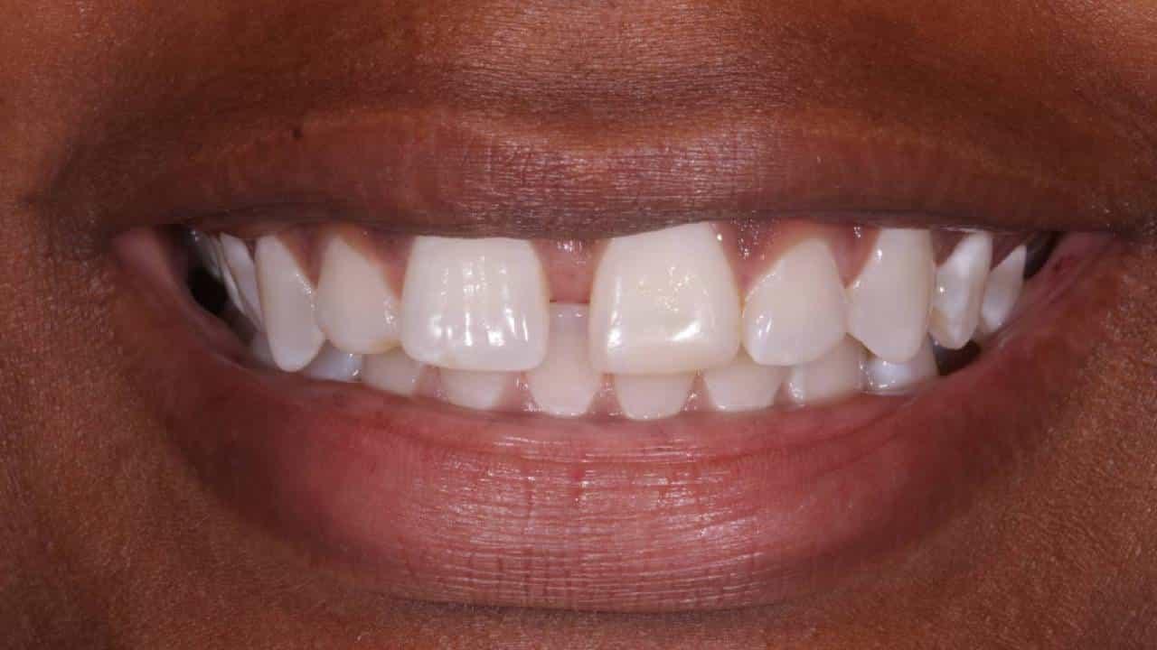Teeth Gap Fortune: ನಿಮ್ಮ ಹಲ್ಲುಗಳ ನಡುವೆ ಅಂತರವಿದೆಯೇ? ಜ್ಯೋತಿಷ್ಯ ಮತ್ತು ಸಾಮುದ್ರಿಕ ಶಾಸ್ತ್ರ ಹೇಳುವುದೇನು ಗೊತ್ತಾ? Teeth Gap Fortune: ನಿಮ್ಮ ಹಲ್ಲುಗಳ ನಡುವೆ ಅಂತರವಿದೆಯೇ? ಜ್ಯೋತಿಷ್ಯ ಮತ್ತು ಸಾಮುದ್ರಿಕ ಶಾಸ್ತ್ರ ಹೇಳುವುದೇನು ಗೊತ್ತಾ?