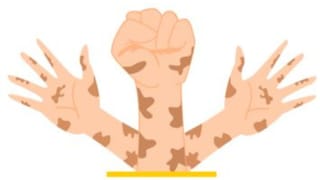 World Leprosy Day 2026: ಜನವರಿ 30 ರಂದೇ ವಿಶ್ವ ಕುಷ್ಠ ರೋಗ ದಿನವನ್ನು ಆಚರಿಸುವುದು ಏಕೆ?