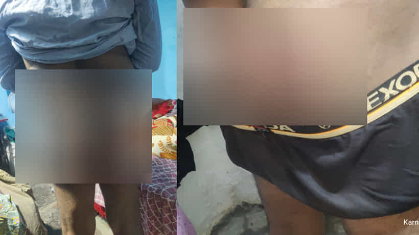 ವಿಚಾರಣೆ ನೆಪದಲ್ಲಿ ಕ್ಯಾನ್ಸರ್ ರೋಗಿ ಮೇಲೆ ಕ್ರೌರ್ಯ?: ಖಾಕಿ ಏಟಿಗೆ ಮುರೀತಾ ವ್ಯಕ್ತಿ ಮೂಳೆ?