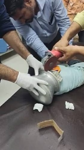 ಆಟವಾಡುತ್ತಿದ್ದಾಗ ಪಾತ್ರೆಯೊಳಗೆ ಸಿಲುಕಿದ ಬಾಲಕನ ತಲೆ