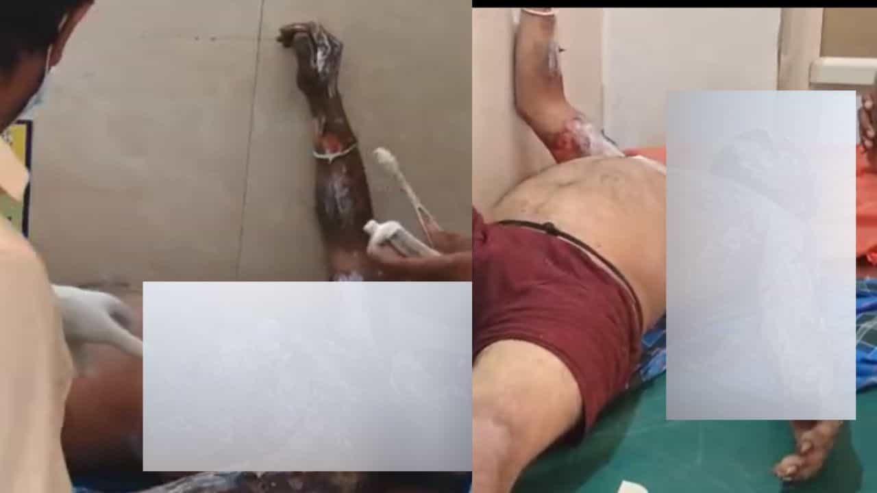 ಚಾಮರಾಜನಗರ: ತನಗೆ ತಾನೇ ಬೆಂಕಿ ಹಚ್ಚಿಕೊಂಡ ಕುಡುಕ! ಮುಂದೇನಾಯ್ತು ನೋಡಿ