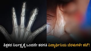 ಶಿಕ್ಷಕರ ನಿರ್ಲಕ್ಷ್ಯಕ್ಕೆ ಒಂದನೇ ತರಗತಿ ವಿದ್ಯಾರ್ಥಿನಿಯ ಬೆರಳುಗಳೇ ಕಟ್! ಬಿಇಓ ಸೇರಿ ನಾಲ್ವರ ವಿರುದ್ಧ ಎಫ್​ಐಆರ್