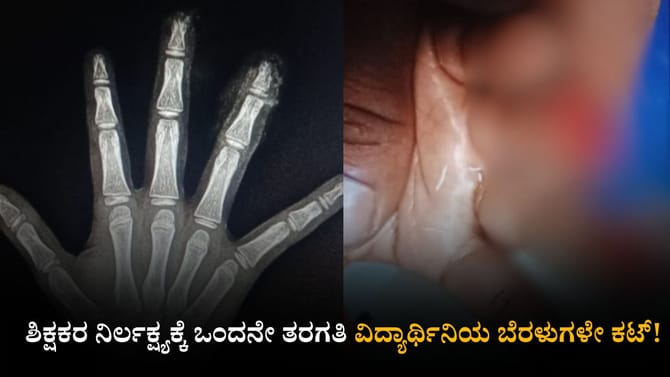 ಶಿಕ್ಷಕರ ನಿರ್ಲಕ್ಷ್ಯಕ್ಕೆ ಒಂದನೇ ತರಗತಿ ವಿದ್ಯಾರ್ಥಿನಿಯ ಬೆರಳುಗಳೇ ಕಟ್!