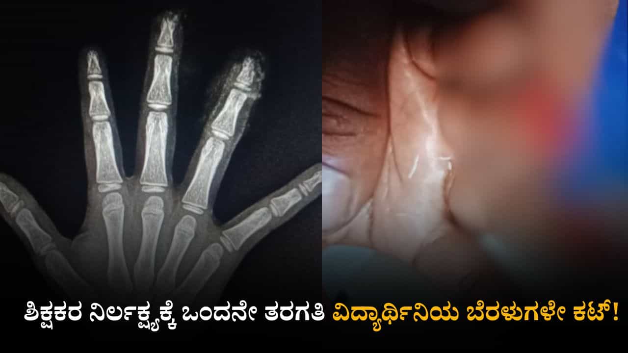 ಶಿಕ್ಷಕರ ನಿರ್ಲಕ್ಷ್ಯಕ್ಕೆ ಒಂದನೇ ತರಗತಿ ವಿದ್ಯಾರ್ಥಿನಿಯ ಬೆರಳುಗಳೇ ಕಟ್! ಬಿಇಓ ಸೇರಿ ನಾಲ್ವರ ವಿರುದ್ಧ ಎಫ್ಐಆರ್ ಶಿಕ್ಷಕರ ನಿರ್ಲಕ್ಷ್ಯಕ್ಕೆ ಒಂದನೇ ತರಗತಿ ವಿದ್ಯಾರ್ಥಿನಿಯ ಬೆರಳುಗಳೇ ಕಟ್! ಬಿಇಓ ಸೇರಿ ನಾಲ್ವರ ವಿರುದ್ಧ ಎಫ್ಐಆರ್