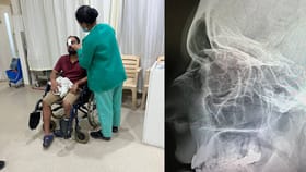 ಡೆಲಿವರಿ ಬಾಯ್​​ ಕೊಟ್ಟ ಪಂಚ್​​​ಗೆ ಗ್ರಾಹಕನ ಮೂಗಿನ ಮೂಳೆ ಮುರಿತ