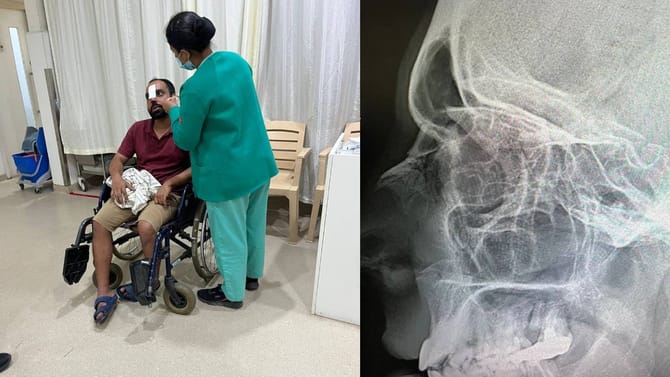 ಡೆಲಿವರಿ ಬಾಯ್​​ ಕೊಟ್ಟ ಪಂಚ್​​​ಗೆ ಗ್ರಾಹಕನ ಮೂಗಿನ ಮೂಳೆ ಮುರಿತ