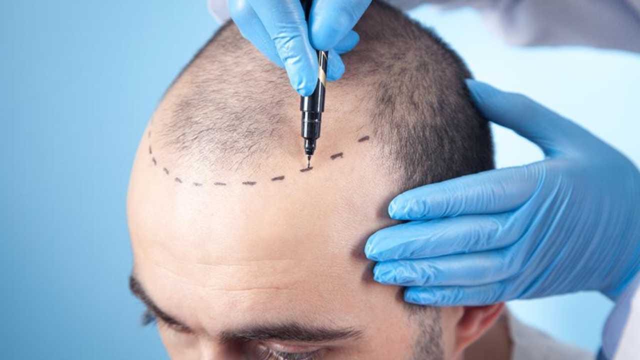 ಹೇರ್ ಟ್ರಾನ್ಸ್ಪ್ಲಾಂಟ್ ಹೆಸರಲ್ಲಿ ಮೋಸ! ವಿಗ್ ಹಾಕಿ ಪಂಗನಾಮ ಹಾಕಿದ್ದ ಸ್ಟುಡಿಯೋಗೆ ಗ್ರಾಹಕ ಕೋರ್ಟ್ ದಂಡ