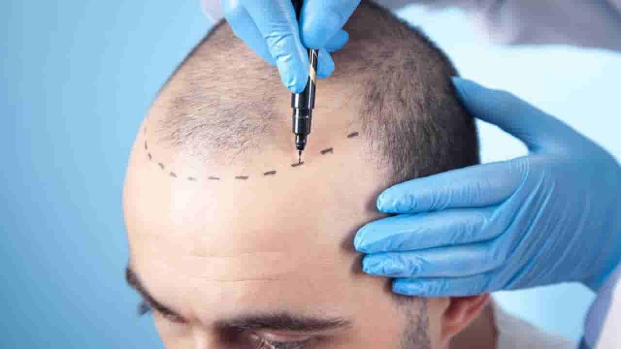 ಹೇರ್ ಟ್ರಾನ್ಸ್ಪ್ಲಾಂಟ್ ಹೆಸರಲ್ಲಿ ಮೋಸ! ವಿಗ್ ಹಾಕಿ ಪಂಗನಾಮ ಹಾಕಿದ್ದ ಸ್ಟುಡಿಯೋಗೆ ಗ್ರಾಹಕ ಕೋರ್ಟ್ ದಂಡ