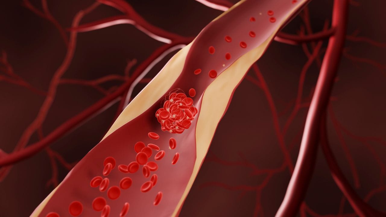 ಈ ಲಕ್ಷಣಗಳು ದೇಹದಲ್ಲಿ ಕಂಡುಬಂದ್ರೆ ನಿಮಗೆ ಹೃದಯದಲ್ಲಿ ಬ್ಲಾಕೇಜ್ ಇರಬಹುದು ಎಚ್ಚರ! ಈ ಲಕ್ಷಣಗಳು ದೇಹದಲ್ಲಿ ಕಂಡುಬಂದ್ರೆ ನಿಮಗೆ ಹೃದಯದಲ್ಲಿ ಬ್ಲಾಕೇಜ್ ಇರಬಹುದು ಎಚ್ಚರ!