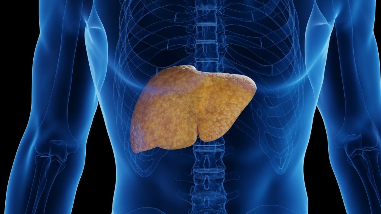 ಆಲ್ಕೋಹಾಲ್ ಸೇವನೆ ಮಾಡದೇ ಇದ್ರೂ ಲಿವರ್ ಡ್ಯಾಮೇಜ್ ಆಗೋದಕ್ಕೆ ಕಾರಣವೇನು ಗೊತ್ತಾ? ಆಲ್ಕೋಹಾಲ್ ಸೇವನೆ ಮಾಡದೇ ಇದ್ರೂ ಲಿವರ್ ಡ್ಯಾಮೇಜ್ ಆಗೋದಕ್ಕೆ ಕಾರಣವೇನು ಗೊತ್ತಾ?